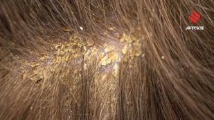 tying hair too tightly