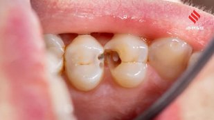 vitamin deficiency and teeth