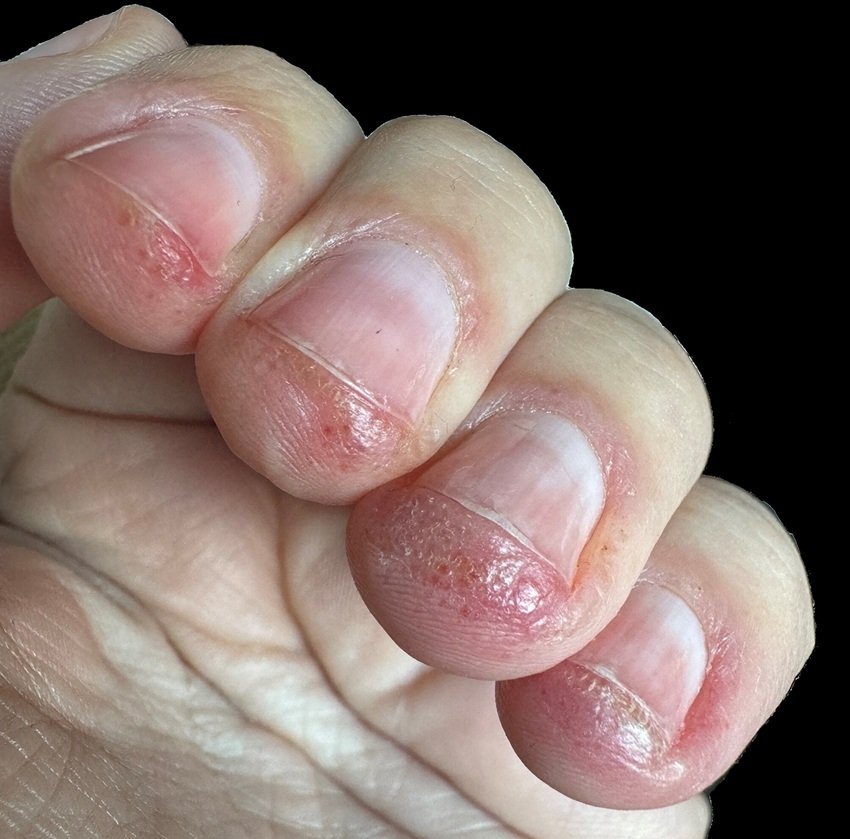 Allergy or skin reaction