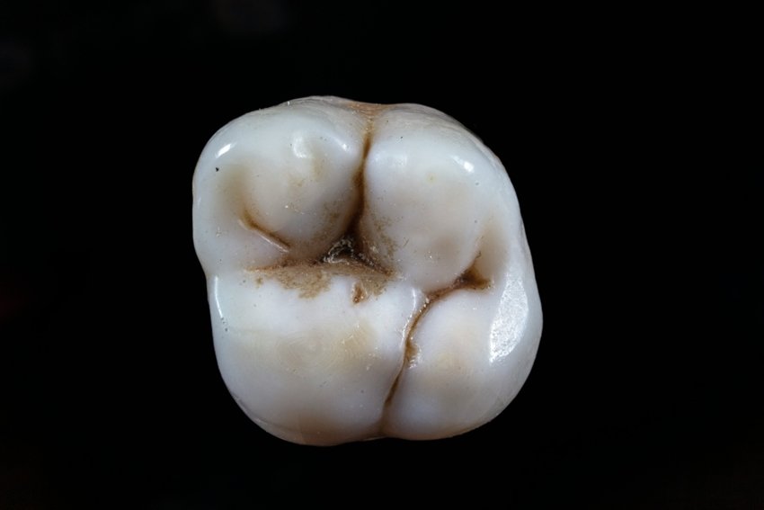 Ayush remedy for gum infection