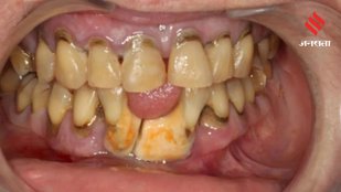 Beat Pyorrhea Naturally Ayurvedic Mouth Rinse Suggested by Baba Ramdev