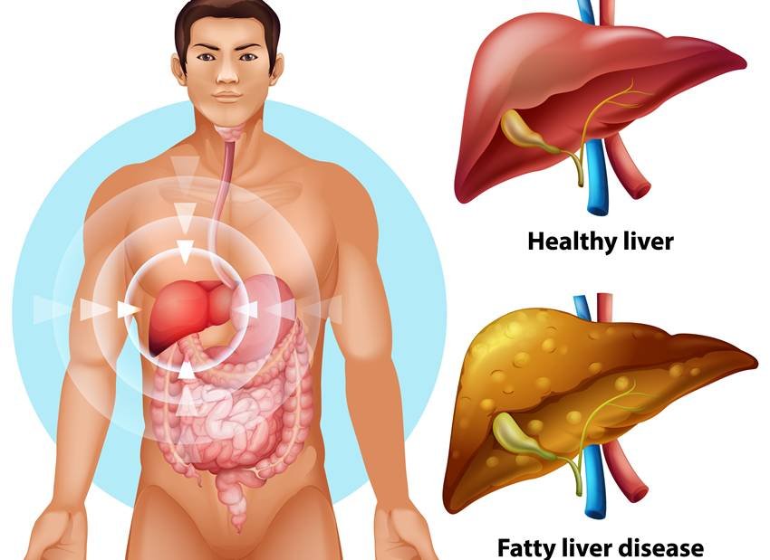 B12 deficiency and fatty liver