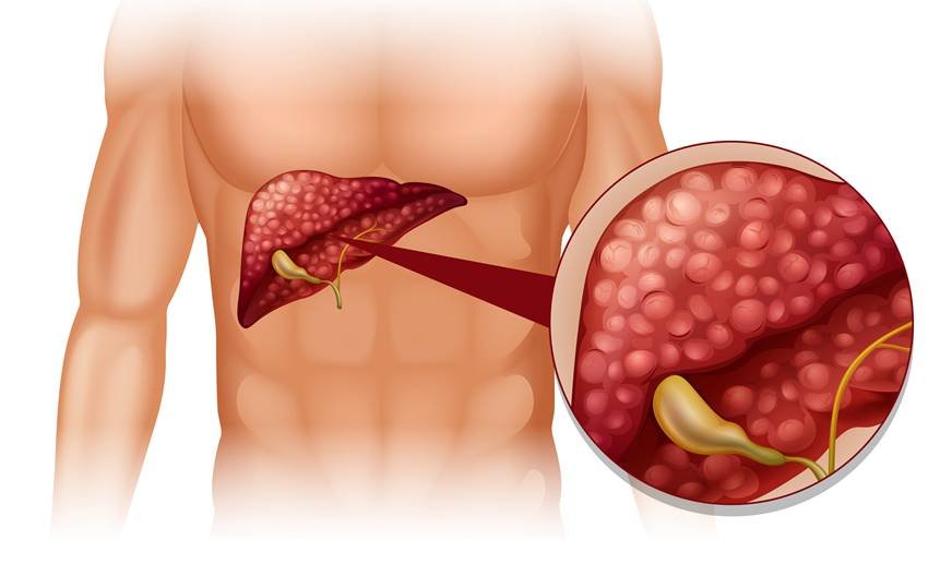 Can B12 deficiency cause fatty liver