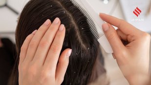 DIY anti-dandruff hair mask