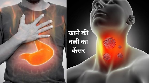 Esophageal cancer, Early warning signs, Dysphagia, Unexplained weight loss, Chest pain, Hoarseness, Chronic cough, Causes of esophageal cancer