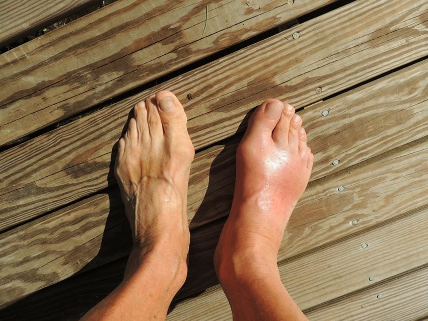 Gout or arthritis