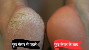 Home Remedies for Dry & Cracked Heels | fati ediyon ke liye gharelu nuskhe | fati ediyon ke liye best cream kaun si hai