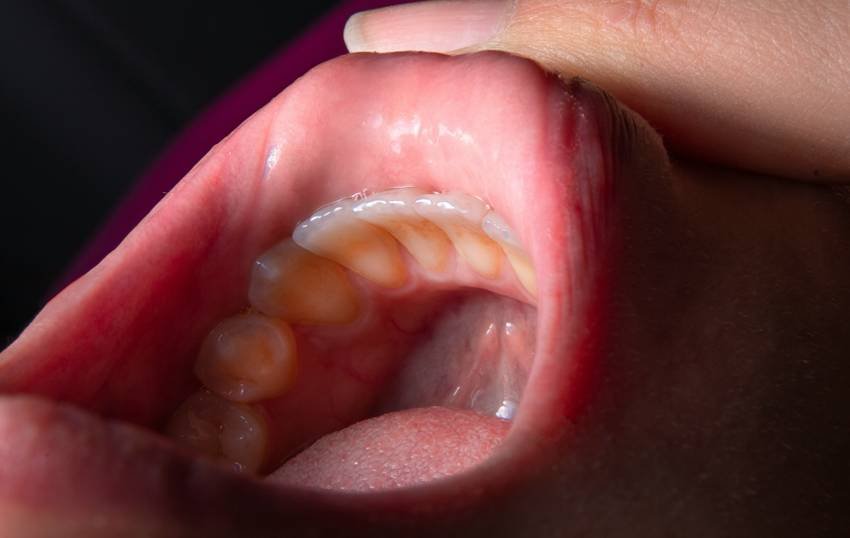 Natural treatment for plaque