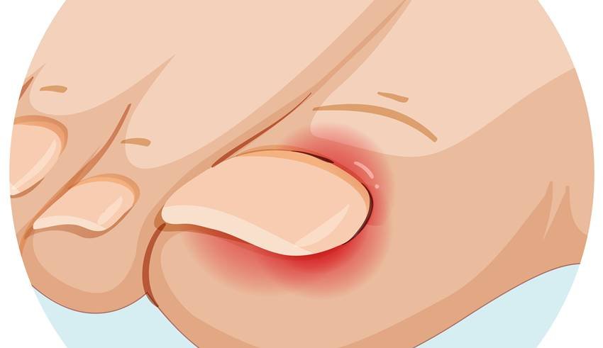  how to treat ingrown nails at home