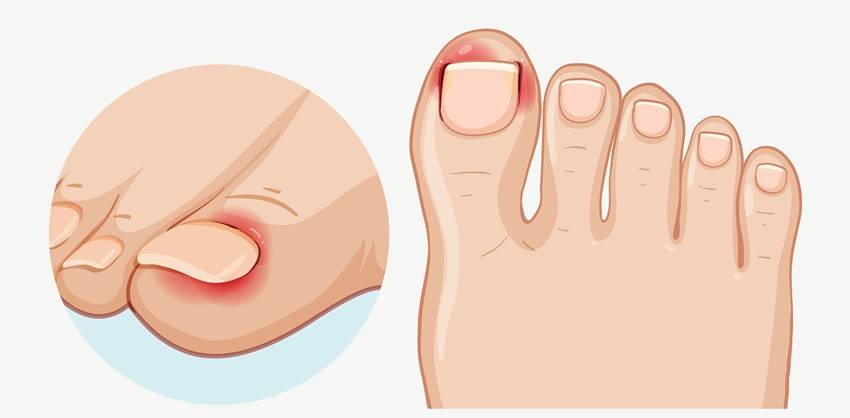 ingrown toenail home treatment