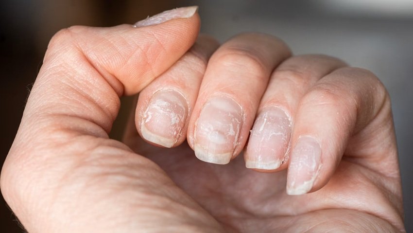 Natural nail weakness