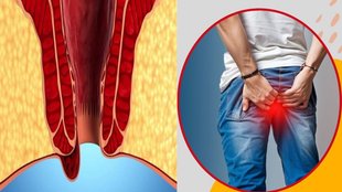 Piles pain relief tips, How to reduce piles swelling, Bleeding piles treatment, Home remedies for piles, Natural ways to treat piles