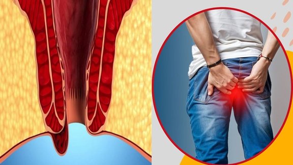 Piles pain relief tips, How to reduce piles swelling, Bleeding piles treatment, Home remedies for piles, Natural ways to treat piles