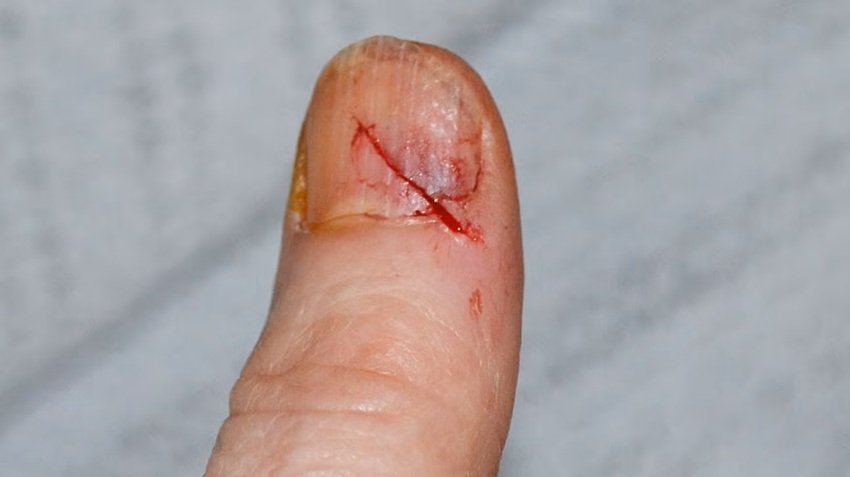 Serious injury due to broken nail