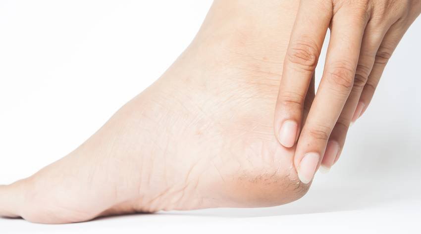 vitamin deficiency for cracked heels