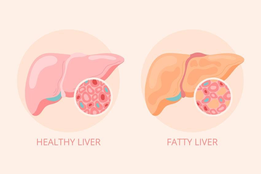 Vitamin deficiency and liver damage