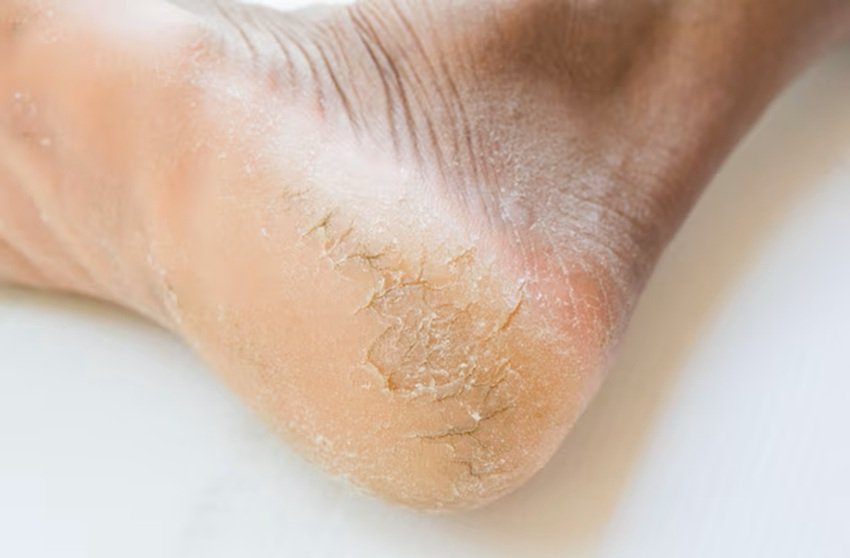 cracked heels home remedies