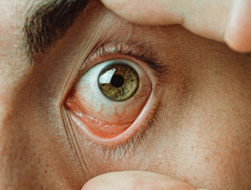 eyeliner causes dry eyes