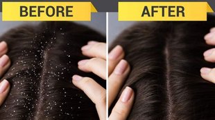 fenugreek curd hair mask, dandruff kam karne ke upay