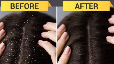 सर्दियों में भी पाएं डैंड्रफ से छुटकारा, दही में मिलाकर लगाएं ये एक चीज