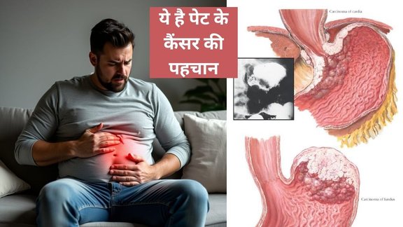 Common Early Signs of Stomach Cancer,nausea and gastric cancer, gastric cancer, stomach cancer, cancer, stomach cancer signs, common signs of stomach cancer