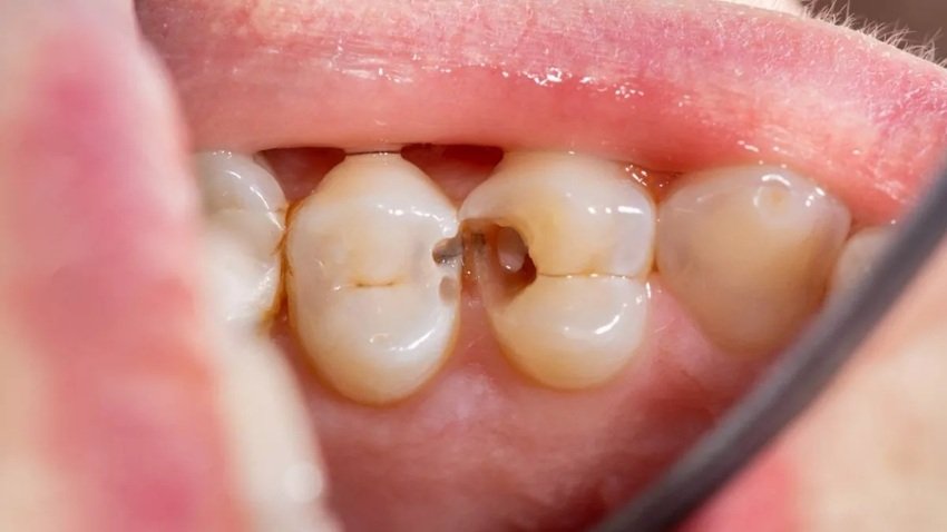 habits that rot teeth