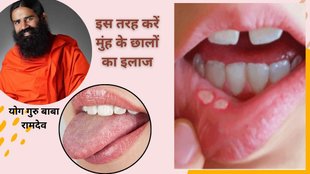 Mouth Ulcer Treatment, Aloe Vera for Mouth Ulcers, Ayurvedic Remedy for Mouth Sores, मुंह के छाले का इलाज, एलोवेरा के फायदे, नीला थोथा से छाले का इलाज