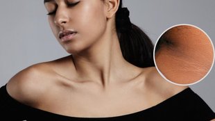 remove dark spots from your neck, neck dark spots, gardan ka kalapan, gardan ka kalapan kaise hataye