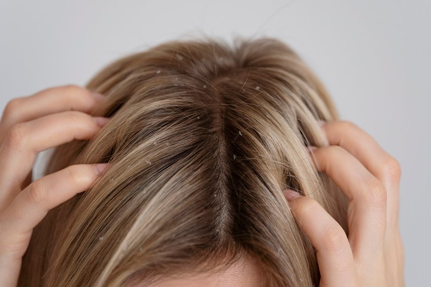 scalp dryness home remedies