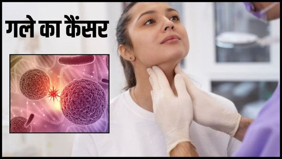 throat cancer , throat cancer Symptoms , throat cancer causes