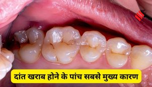 Common Causes of teeth Decay