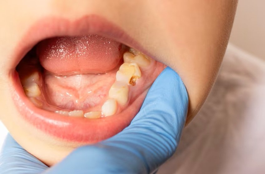 Ayurvedic dental remedies