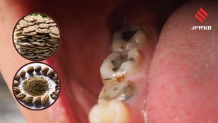 Cavity and Gum Problems These Natural Remedies Could Save Your Smile