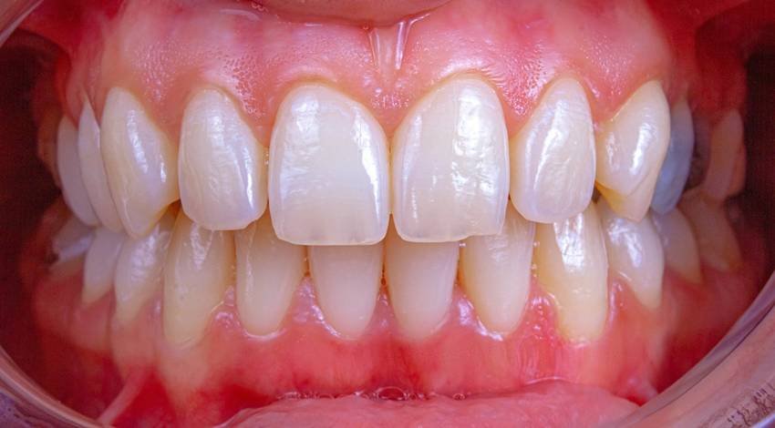 reasons for weak teeth