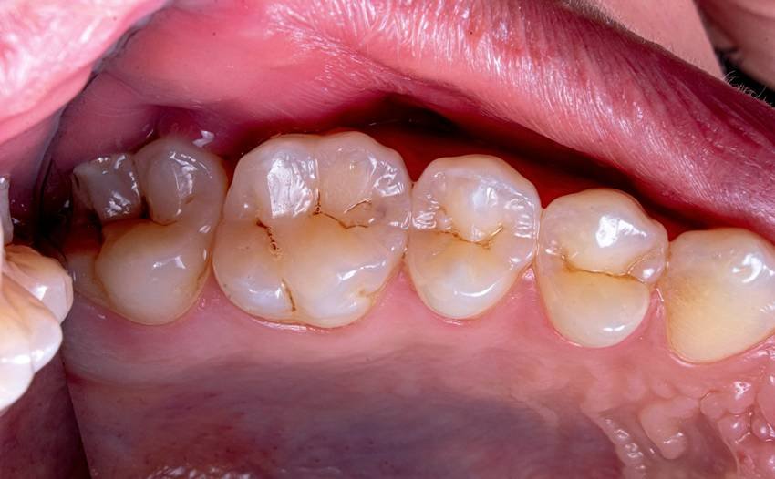 causes of tooth damage