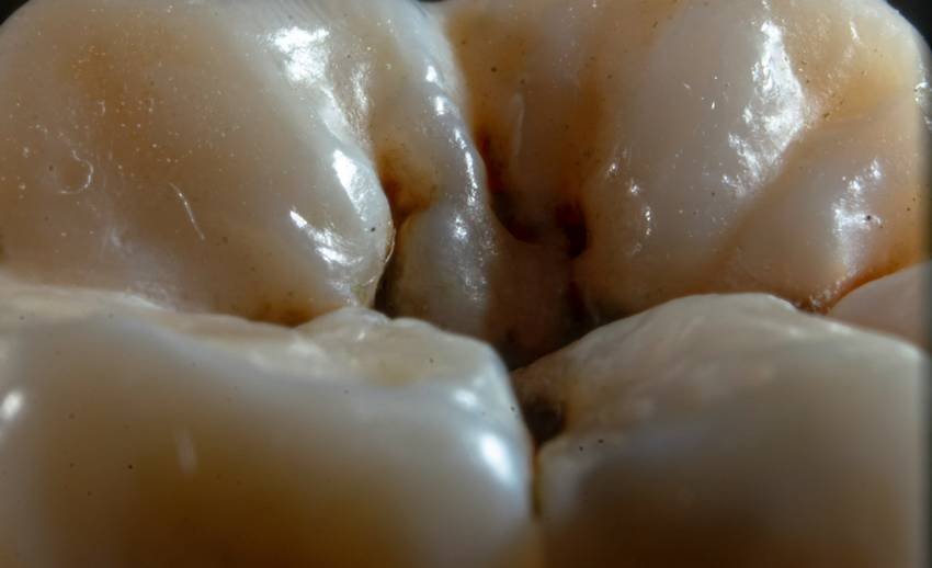 main reasons for tooth decay