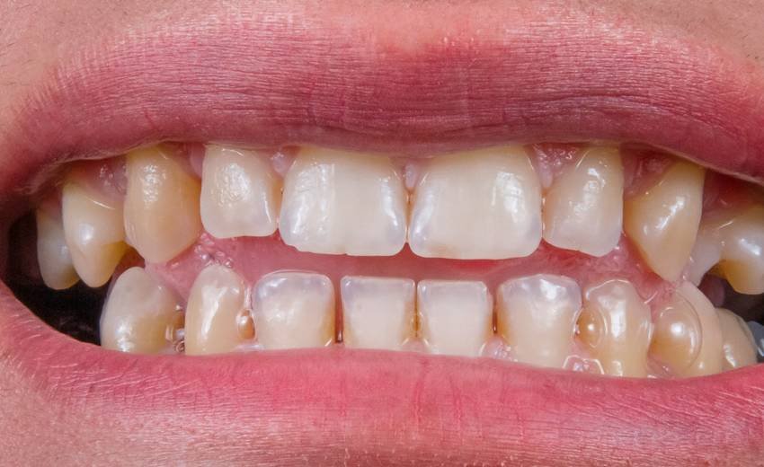 causes of tooth decay