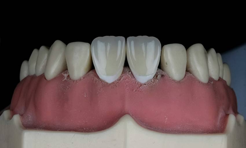 reasons for cavities in teeth