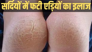 Cracked Heels home Remedies, How to fix cracked heels permanently, fati ediyo ka gharelu upay in hindi
