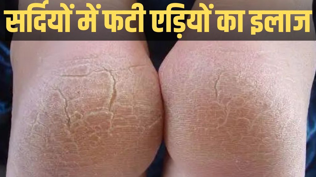 Cracked Heels home Remedies, How to fix cracked heels permanently, fati ediyo ka gharelu upay in hindi