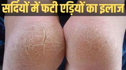 Cracked Heels Remedies: सर्दियों में फट रही हैं एड़ियां? इन घरेलू उपायों से स्किन होगी एकदम मुलायम