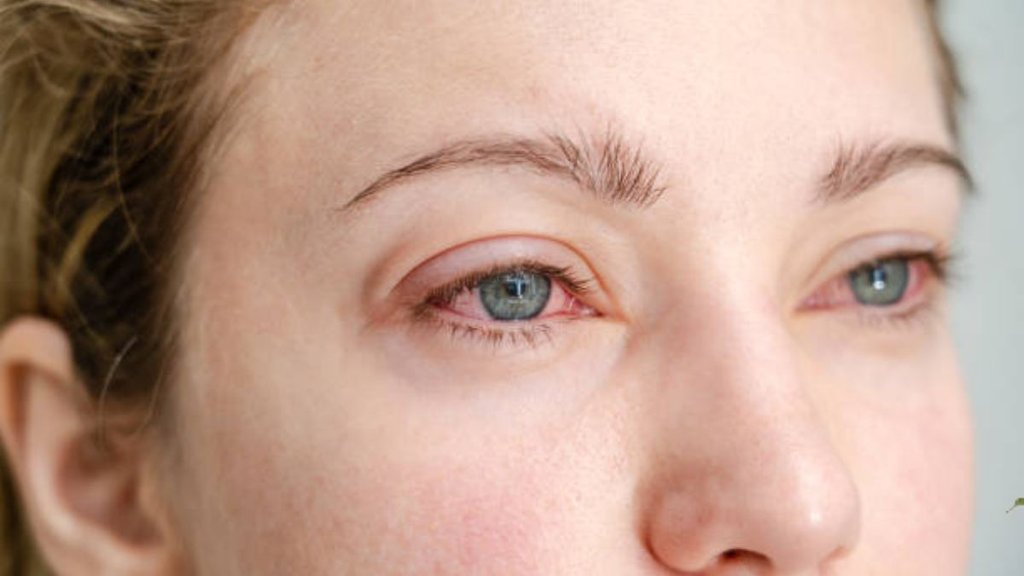 Eye Redness Cause, Eye Redness, आंखें लाल होने के कारण, red eyes causes in hindi, eye infection symptoms hindi, allergy se aankhen lal, dry eyes problem hindi, computer screen se aankhen lal, eye health tips hindi, आंखें लाल रहने के कारण, आंखों में लालिमा क्यों होती है, आंखें हमेशा लाल क्यों रहती हैं, आंखों में जलन और लालपन, आंखें लाल रहने का इलाज, प्रदूषण से आंखें लाल होना, आंखों में लगातार लालपन क्यों रहता है, pollution se aankhen lal hona, aankhon mein lagatar lalpan kyon hota hai, eye infection symptoms hindi, red eyes problem in hindi, aankhen hamesha lal kyon rehti hain, eye health tips hindi