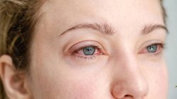 दिन-रात लाल रहती हैं आंखें? सिर्फ प्रदूषण नहीं, ये वजहें भी हो सकती हैं जिम्मेदार