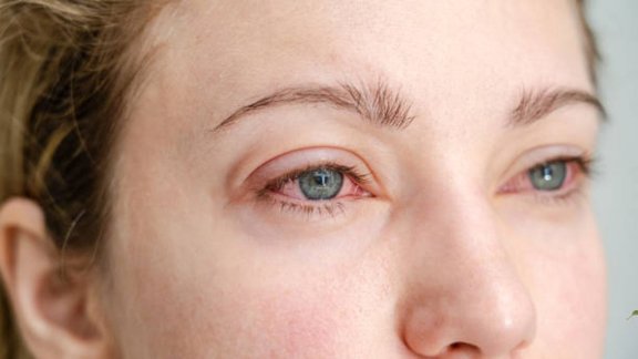 Eye Redness Cause, Eye Redness, आंखें लाल होने के कारण, red eyes causes in hindi, eye infection symptoms hindi, allergy se aankhen lal, dry eyes problem hindi, computer screen se aankhen lal, eye health tips hindi, आंखें लाल रहने के कारण, आंखों में लालिमा क्यों होती है, आंखें हमेशा लाल क्यों रहती हैं, आंखों में जलन और लालपन, आंखें लाल रहने का इलाज, प्रदूषण से आंखें लाल होना, आंखों में लगातार लालपन क्यों रहता है, pollution se aankhen lal hona, aankhon mein lagatar lalpan kyon hota hai, eye infection symptoms hindi, red eyes problem in hindi, aankhen hamesha lal kyon rehti hain, eye health tips hindi
