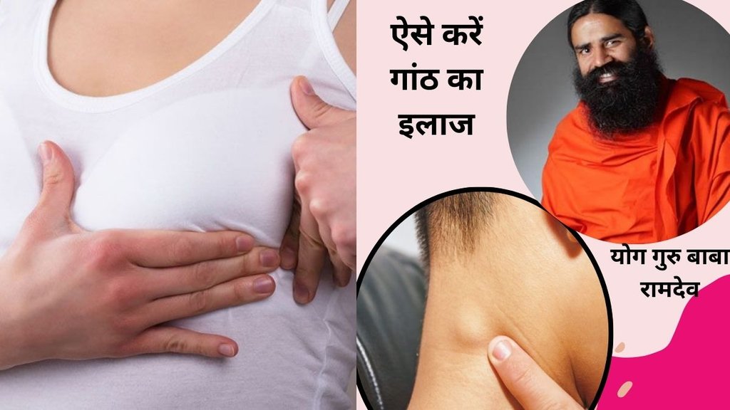 lump in body,Ayurvedic remedy for lumps, Baba Ramdev tips, TB lump relief, Fatty lump treatment ayurveda, Ayurvedic treatment for cyst, गांठ का आयुर्वेदिक इलाज, lump in body,Ayurvedic remedy for lumps, Baba Ramdev tips, TB lump relief, Fatty lump treatment ayurveda, Ayurvedic treatment for cyst, गांठ का आयुर्वेदिक इलाज,