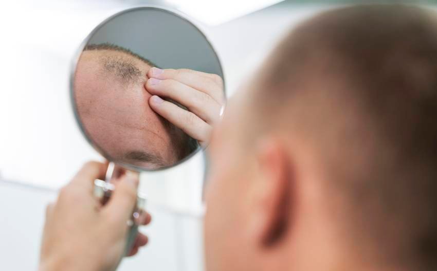 hair fall due to vitamin deficiency