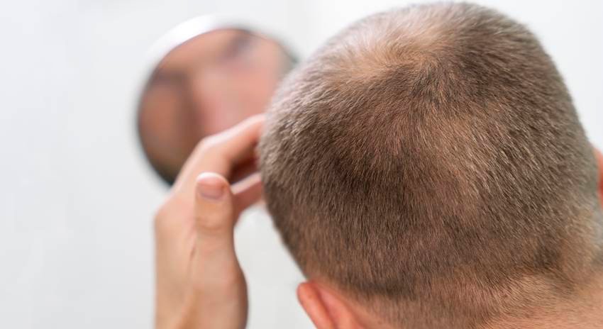 vitamins that cause baldness when deficient