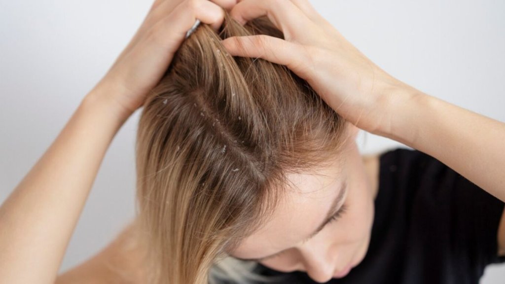 Home Remedies for Dandruff, Dandruff and Itchy Scalp, rusi se chutkara pane ke upay