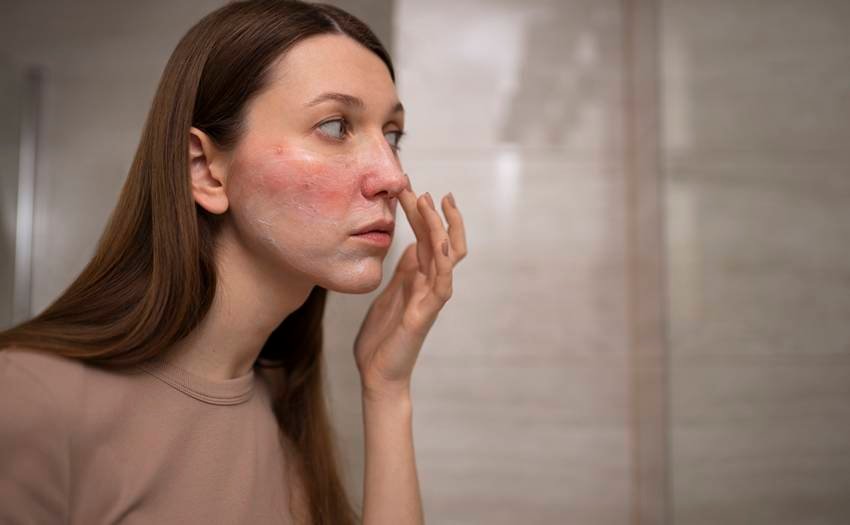 dry skin winter home remedies