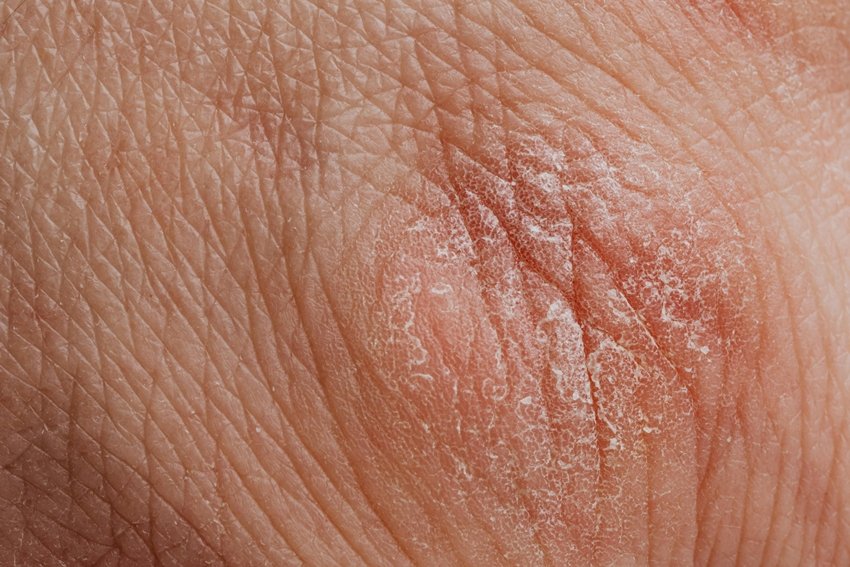 Itching skin treatment